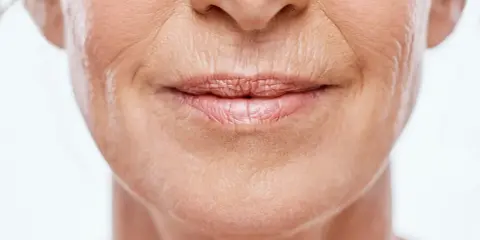 Gros plan sur le visage d'une femme, montrant les rides et ridules qui témoignent du vieillissement de la peau.