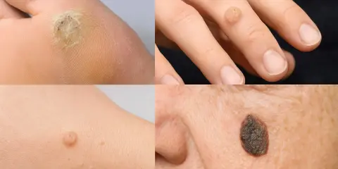 Primo piano di una verruca sul dito di una mano, un'altra sul piede e una lesione cutanea sul viso.