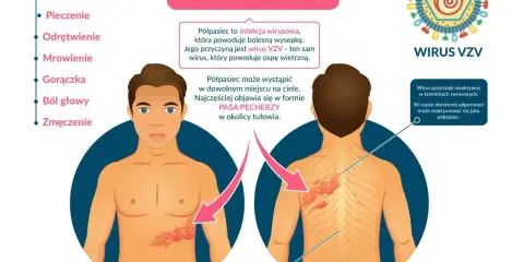 Ilustracja przedstawia objawy półpaśca, w tym ból, pieczenie i wysypkę na ciele, wskazując na nietypowe objawy półpaśca.