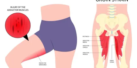 Illustration zeigt Adduktoren-Schmerzen im Leistenbereich, mit hervorgehobenen Muskeln und einer roten Zone, die eine Zerrung signalisiert.