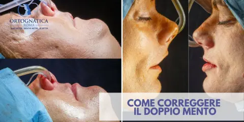Prima e dopo un intervento per correggere il doppio mento. Immagini ravvicinate del viso di una persona durante una procedura medica.