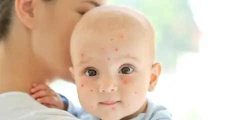 Un bébé est tenu par sa mère, son visage est couvert de petites taches rouges de varicelle.