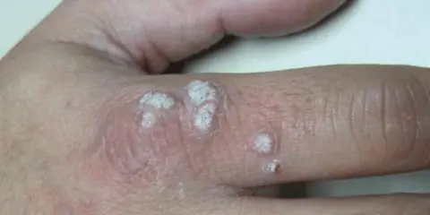 Verrugas en la mano, con aspecto escamoso y blanquecino. La diferencia entre verruga y condiloma es importante para el diagnóstico.