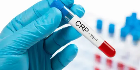 Ręka w niebieskiej rękawiczce trzyma probówkę z napisem "CRP - TEST". Badanie CRP pomaga ocenić stan zapalny w organizmie.