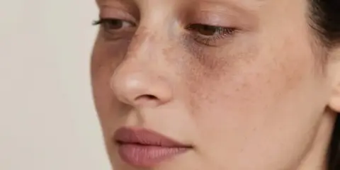 Visage d'une femme avec des taches brunes sous les yeux, évoquant le masque de grossesse du 1er trimestre.