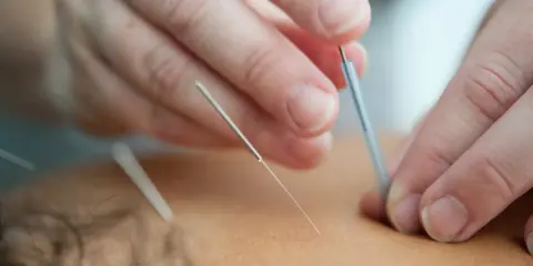 Dłonie terapeuty wprowadzają igły do akupunktury. Często zadajemy sobie pytanie, jak często stosować suche igłowanie dla najlepszych efektów.