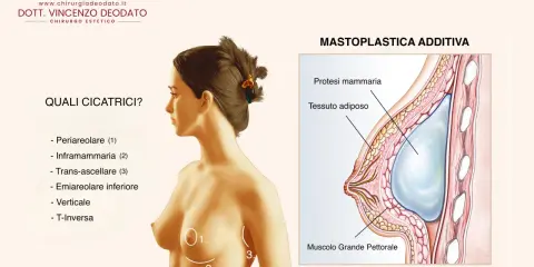 Illustrazione anatomica di un seno con protesi mammaria. Si evidenziano le possibili cicatrici post-mastoplastica e la posizione della protesi rispetto al muscolo pettorale.