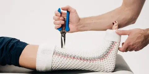 Lekarz zdejmuje gips, by po jakim czasie można zmienić gips na ortezę. Widoczne są nożyczki i biały opatrunek.
