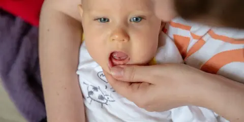 Widok na buzię niemowlaka, któremu rodzic delikatnie podnosi wargę, ukazując, jak wygląda przebijający się zabek.