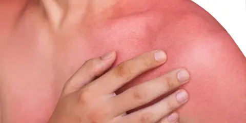 En person med kraftigt solbränd, röd hud på axlar och bröst. Huden ser ut att ha feber efter för mycket sol.