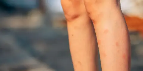 Jambes d'enfant couvertes de rougeurs, un bouton de moustique qui ne part pas, avec quelques éraflures sur les genoux.
