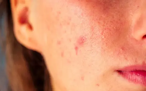 Pryszcz który nie znika: co oznacza i kiedy iść do dermatologa