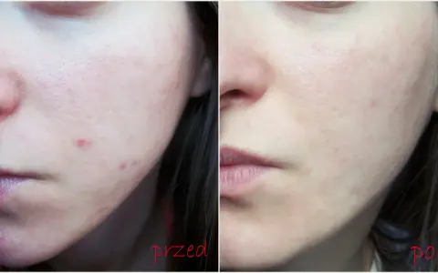 Przed i po: skóra z niedoskonałościami i zaczerwienieniami, a następnie wygładzona i oczyszczona. Kwas glikolowy efekty widoczne!