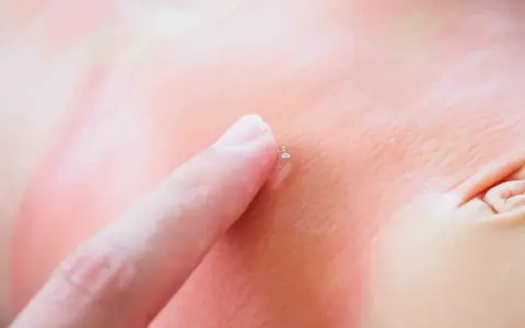 Un doigt touche délicatement un bouton de stress sur une peau rougie, peut-être après une exposition au soleil.