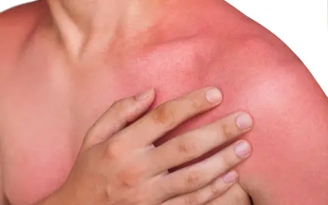 En person med kraftigt solbränd, röd hud på axlar och bröst. Känns som att vara allergisk mot solen.