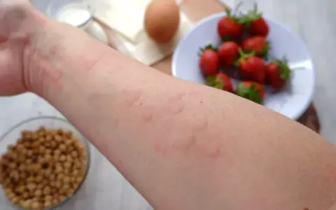 Ręka z wysypką, objawem alergii pokarmowej. W tle truskawki, jajko i nasiona.