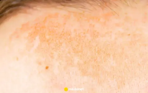 Skóra z zaczerwienieniem i przebarwieniami, objawy fotodermatozy – uczulenia na słońce. Widoczne włoski i pieprzyk.