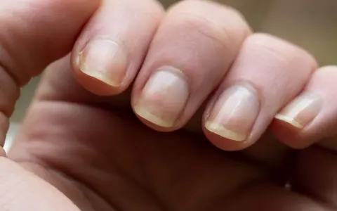 Gros plan sur des doigts montrant un ongle jaune, signe possible d'une mycose ou d'une autre affection.