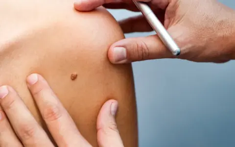 Examen d'un grain de beauté sur l'épaule, un médecin utilise un stylo pour le marquer.