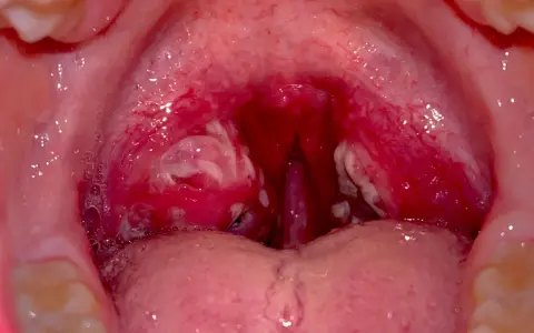 Gola infiammata con placche biancastre, indicative di faringite da streptococco. Le tonsille sono rosse e gonfie.