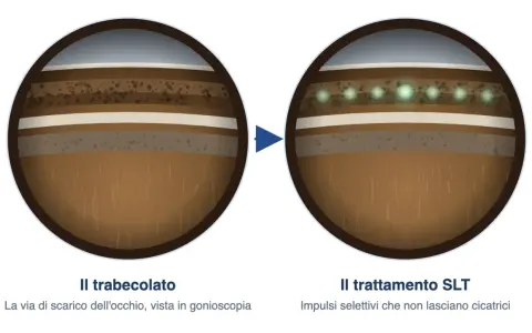 Trabeculoplastica laser selettiva: prima e dopo il trattamento SLT. Impulsi laser che migliorano il drenaggio oculare, minimizzando i rischi di cicatrici.