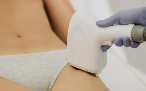 Depilacja laserowa bikini: Czy wiesz, jak to działa? Pełny przewodnik