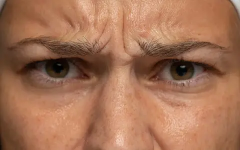 Nahaufnahme der Stirn einer Frau mit sichtbarer Zornesfalte mit 30. Die Augen sind zusammengekniffen, die Brauen nach unten gezogen.
