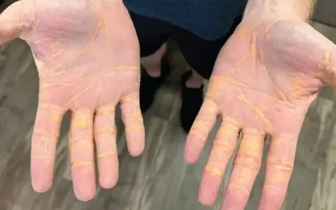 Dłonie z żółtymi zmianami skórnymi, mogącymi świadczyć o wysokim cholesterolu.