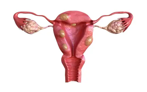 Anatomical illustration of a uterus with multiple fibroids and ovaries.