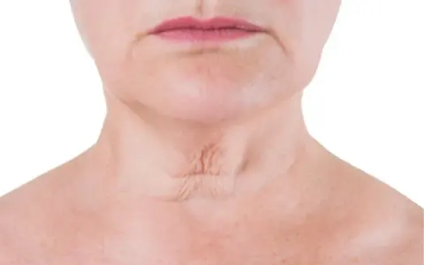 Primer plano del cuello de una mujer, mostrando arrugas en el cuello y la piel con pecas.