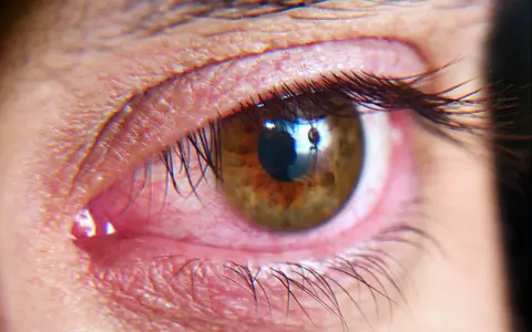 Occhio arrossato e irritato, possibile sintomo di sindrome dell'occhio secco cause.