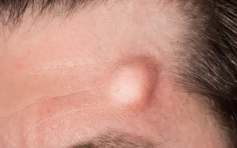 Gros plan sur un front humain, montrant un bouton sous cutané proéminent, légèrement rouge, près de la ligne des cheveux.