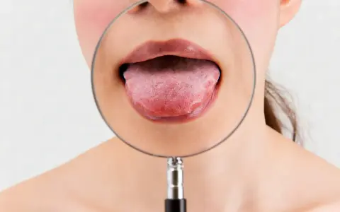 Język pod lupą. Szukasz zamiennika Solcoseryl na afty?