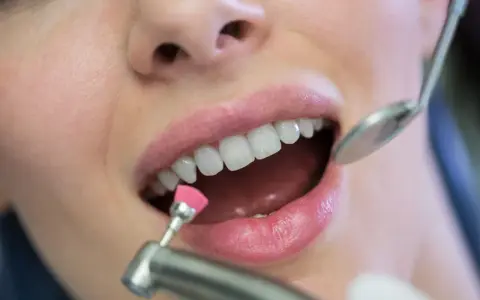 Zabieg fluoryzacji z użyciem szczoteczki i lusterka dentystycznego.