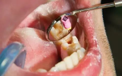 Dentysta wykonuje leczenie kanałowe martwego zęba, używając narzędzi widocznych w lusterku stomatologicznym.