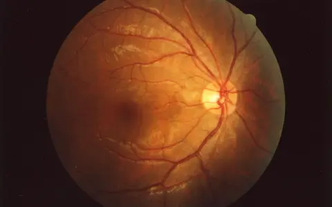 Il fundus oculi cos'è? Un'immagine della retina con vasi sanguigni rossi e aree biancastre, rivelando la sua complessa struttura interna.