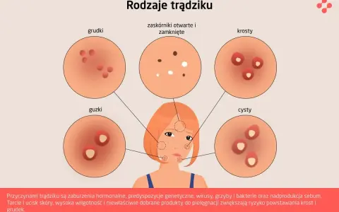 Ilustracja przedstawia różne rodzaje trądziku: grudki, zaskórniki, krosty, guzki i cysty.