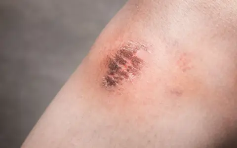 Strup na kolanie, który zaczął się goić. Chcesz wiedzieć, co zrobić, żeby strup szybciej odpadł?