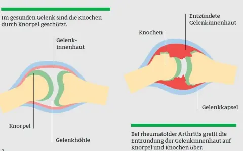 Die häufigsten Symptome der rheumatoiden Arthritis und ihre Folgen