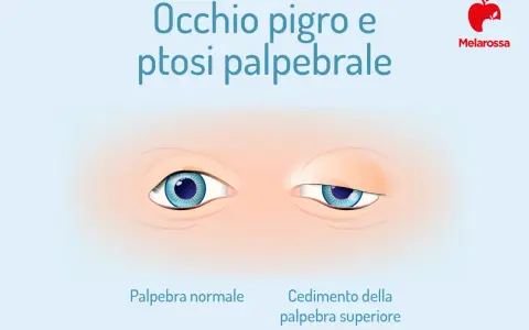 Occhio pigro e ptosi: confronto tra palpebra normale e cedimento. Ambliope cosa significa?