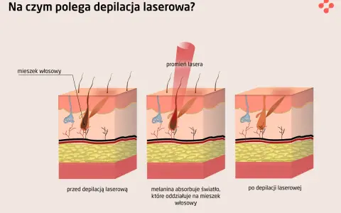 Ilustracja pokazuje, jak działa depilator laserowy: promień lasera trafia w mieszek włosowy, niszcząc go.