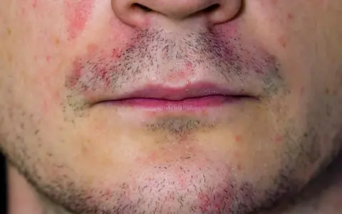 Gesichtshaut trocken & gerötet? So beruhigen Sie sie!