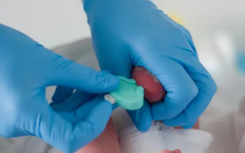 Mani con guanti blu eseguono il test di Guthrie su un neonato, raccogliendo una goccia di sangue dal tallone.