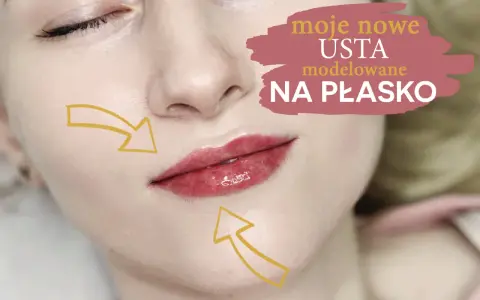 Efekt 1 ml kwasu hialuronowego na ustach. Modelowanie "na płasko" dla naturalnego wyglądu.