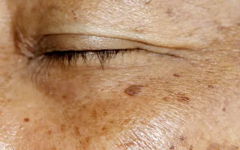 Nahaufnahme der Haut um das Auge mit Altersflecken. Ein Beispiel für Hautveränderungen, die mit Methoden zur Altersfleckenentfernung behandelt werden können.