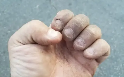 Brudne palce i zniszczone paznokcie, ślady po obgryzaniu paznokci.