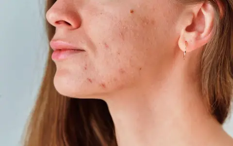 Primer plano de una mujer con granos en el entrecejo y mejillas, mostrando la textura de su piel.