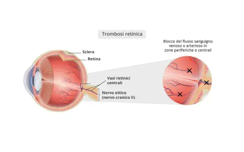 Diagramma occhio: trombosi retinica con blocco flusso sanguigno. Sintomi visivi possono manifestarsi in zone periferiche o centrali.
