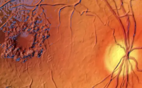 Edema maculare cistoide: la macula appare gonfia e irregolare, con aree scure che suggeriscono le cause. Vasi sanguigni retinici visibili.