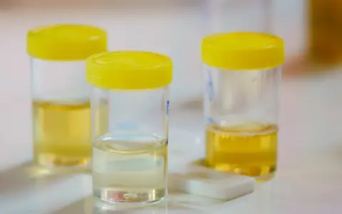 Pojemniki z żółtymi nakrętkami zawierają próbki moczu do analizy. Na stole leży też test diagnostyczny, który może wykryć np. urobilinogen w moczu.